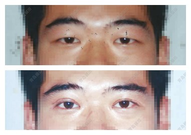 男士切开双眼皮手术前、术后对比