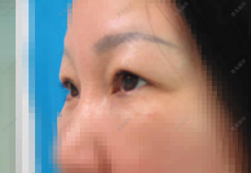 眉下切口提眉改善眼皮耷拉手术前
