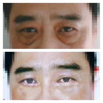男士眼袋行外路眼袋祛除术前、手术后拆张时