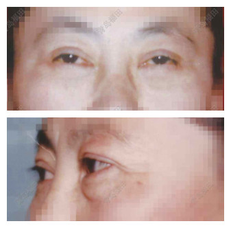 眼袋行外路眼袋祛除术前、术后对比
