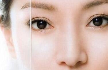 韩式双眼皮整形有安歇特点？效果好不好？