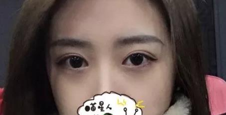 割双眼皮